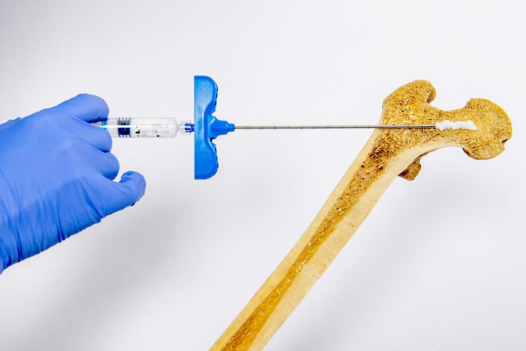 "Injectable bone" gel may be a radically better treatment for osteoporosis